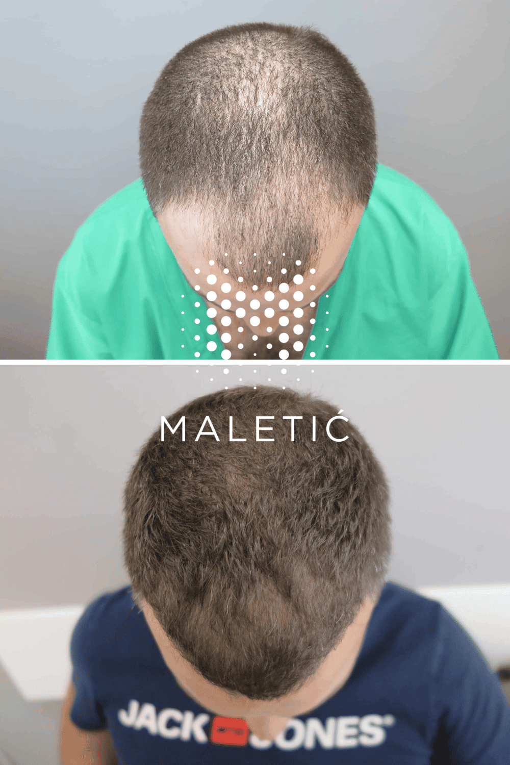 fue-transplantacija-kose-rezultati