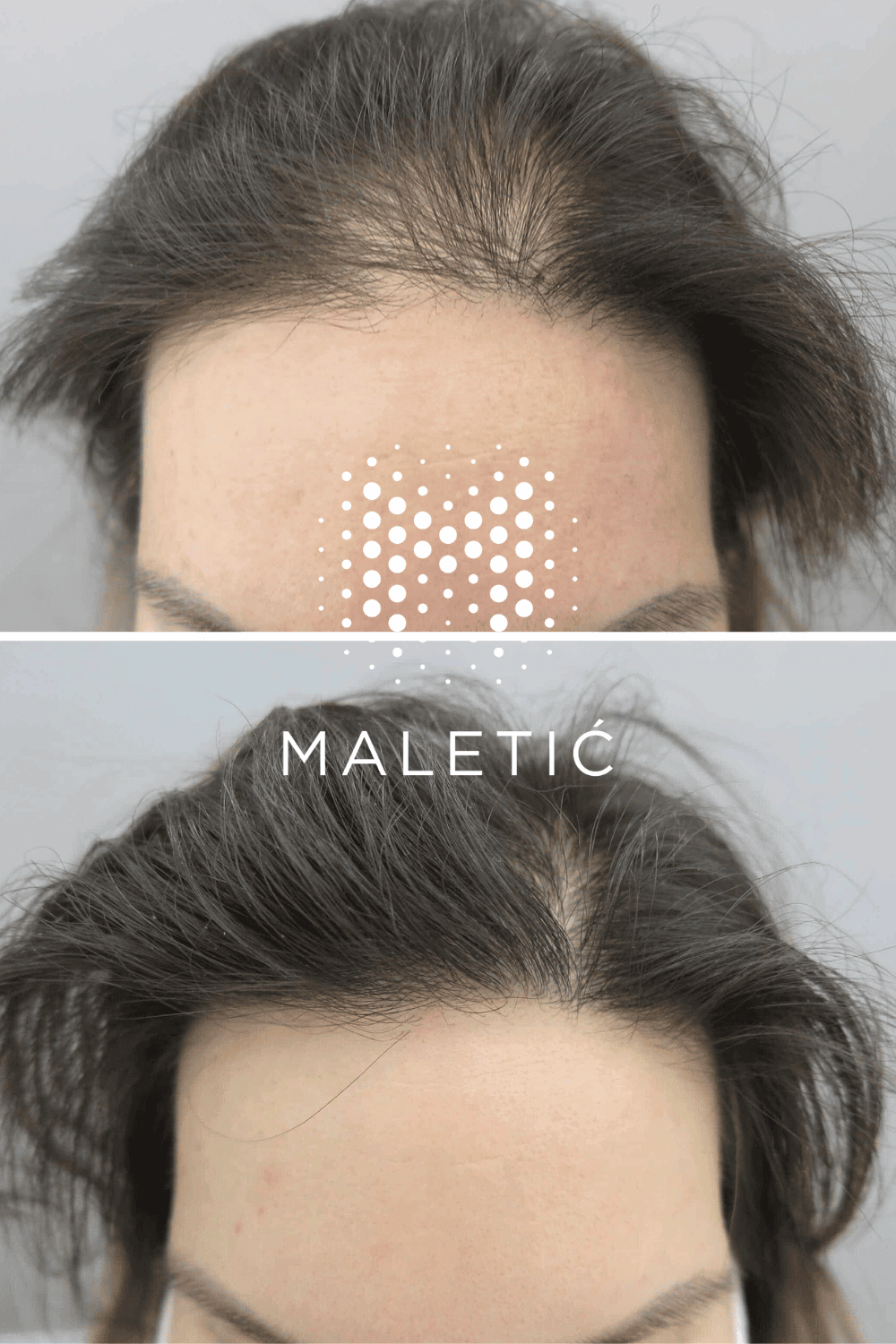 gubitak-kose-rjesenje-transplantacija