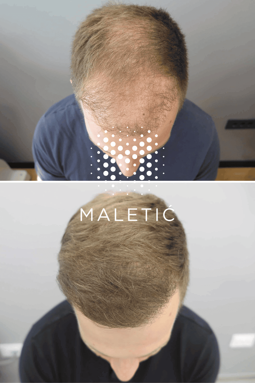 presadjivanje-kose-prije-i-poslije