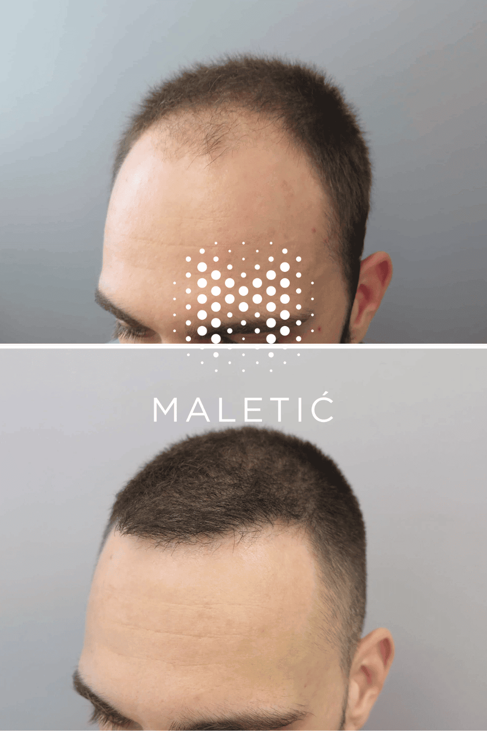 prirodni-rezultati-transplantacije-kose