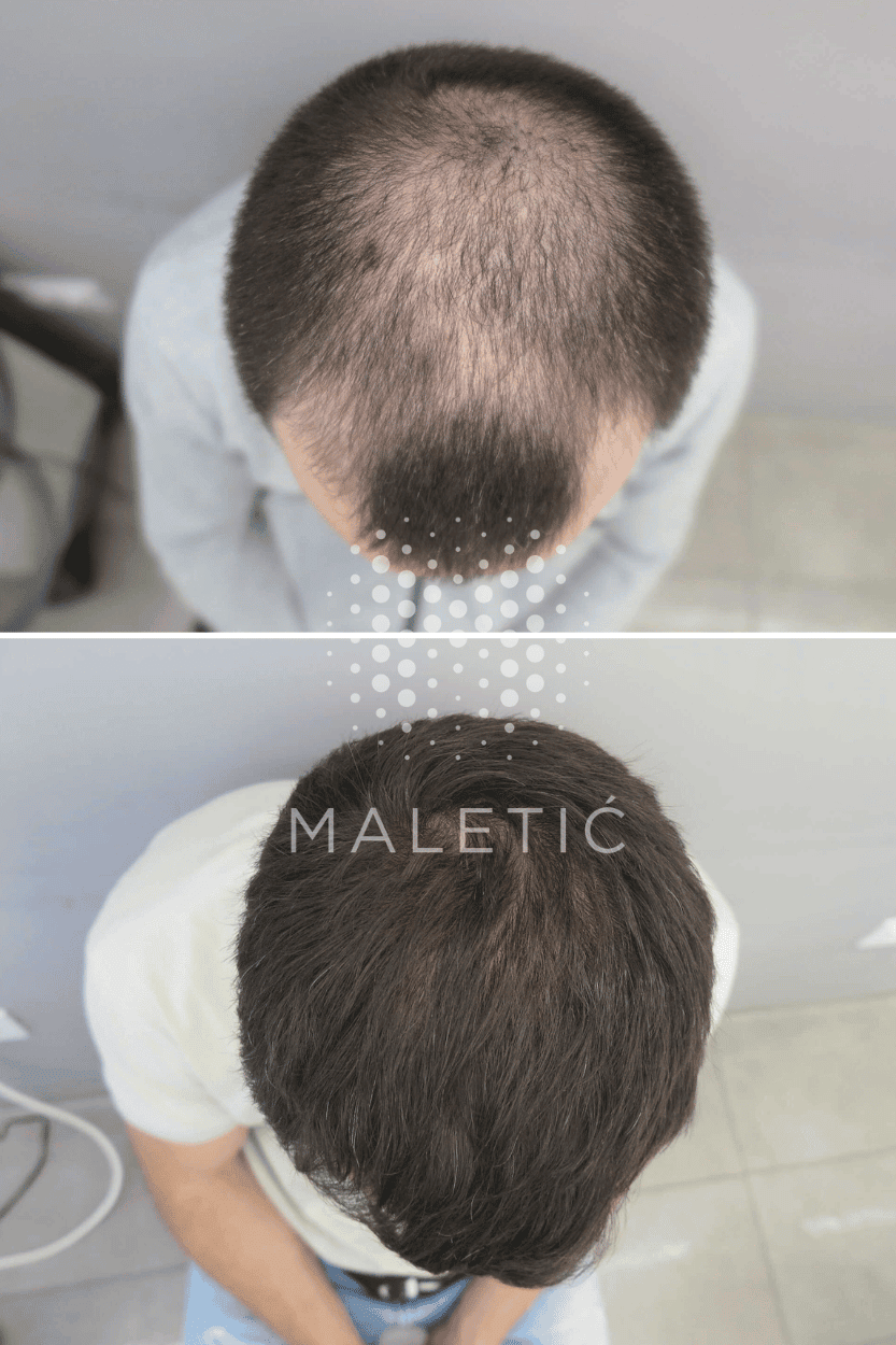 prp-terapija-za-rast-kose-prije-poslije