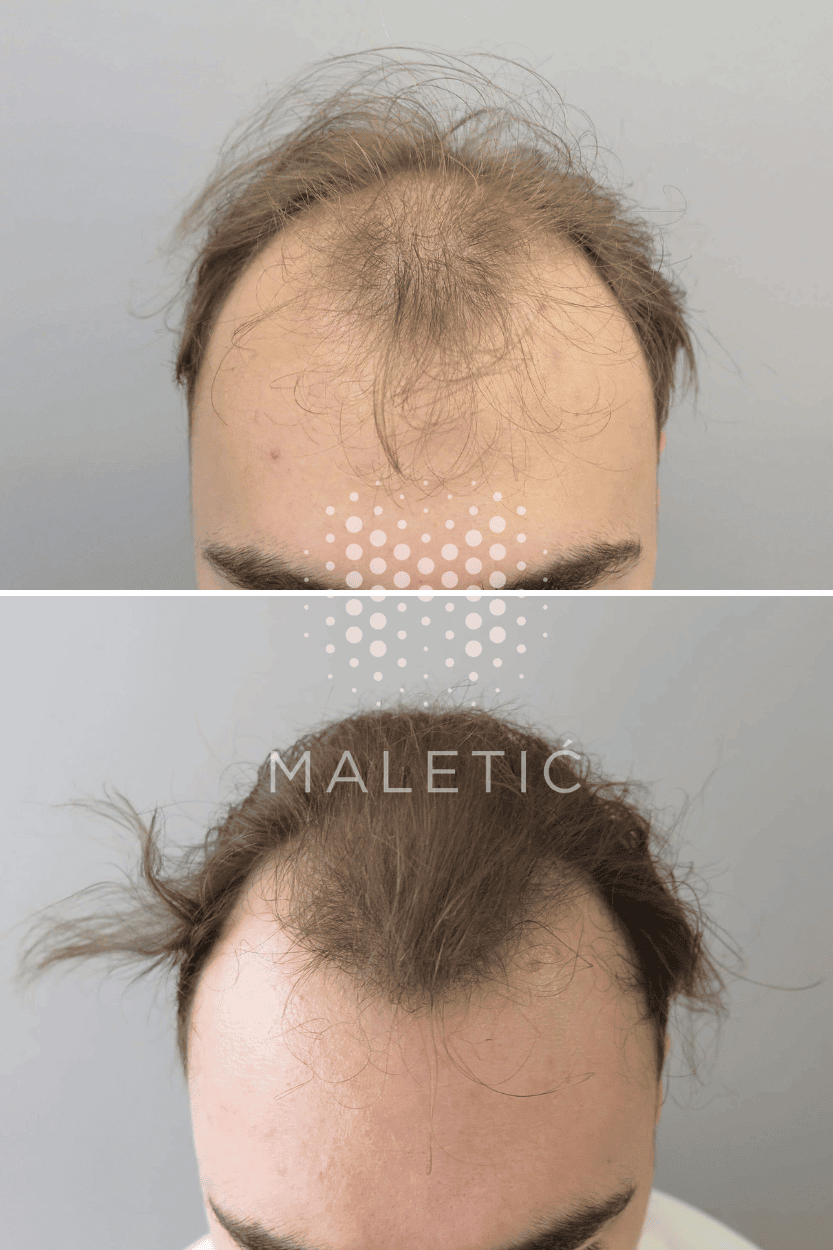 prp-tretman-vlasista-prije-poslije