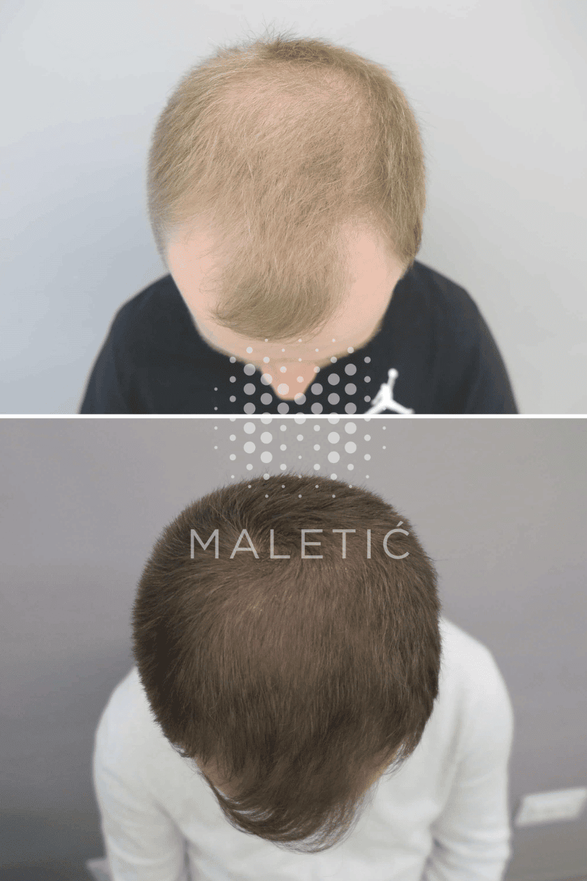 rezultati-prp-tretmana-vlasista