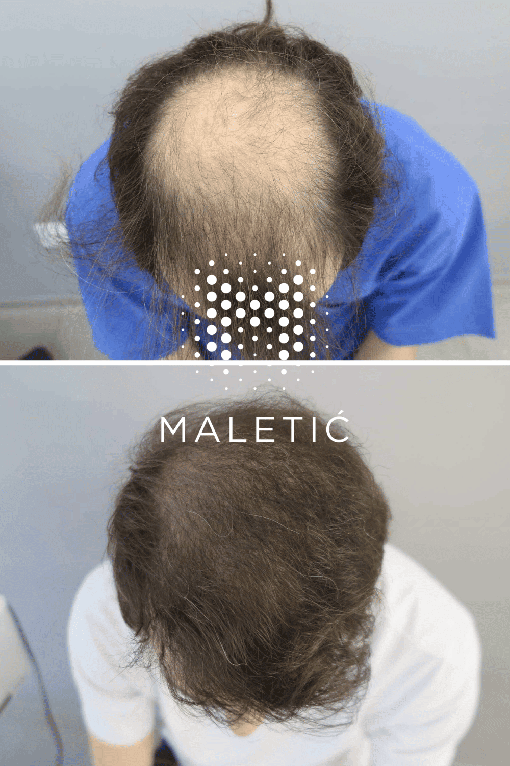 transplantacija-kose-prije-i-poslije