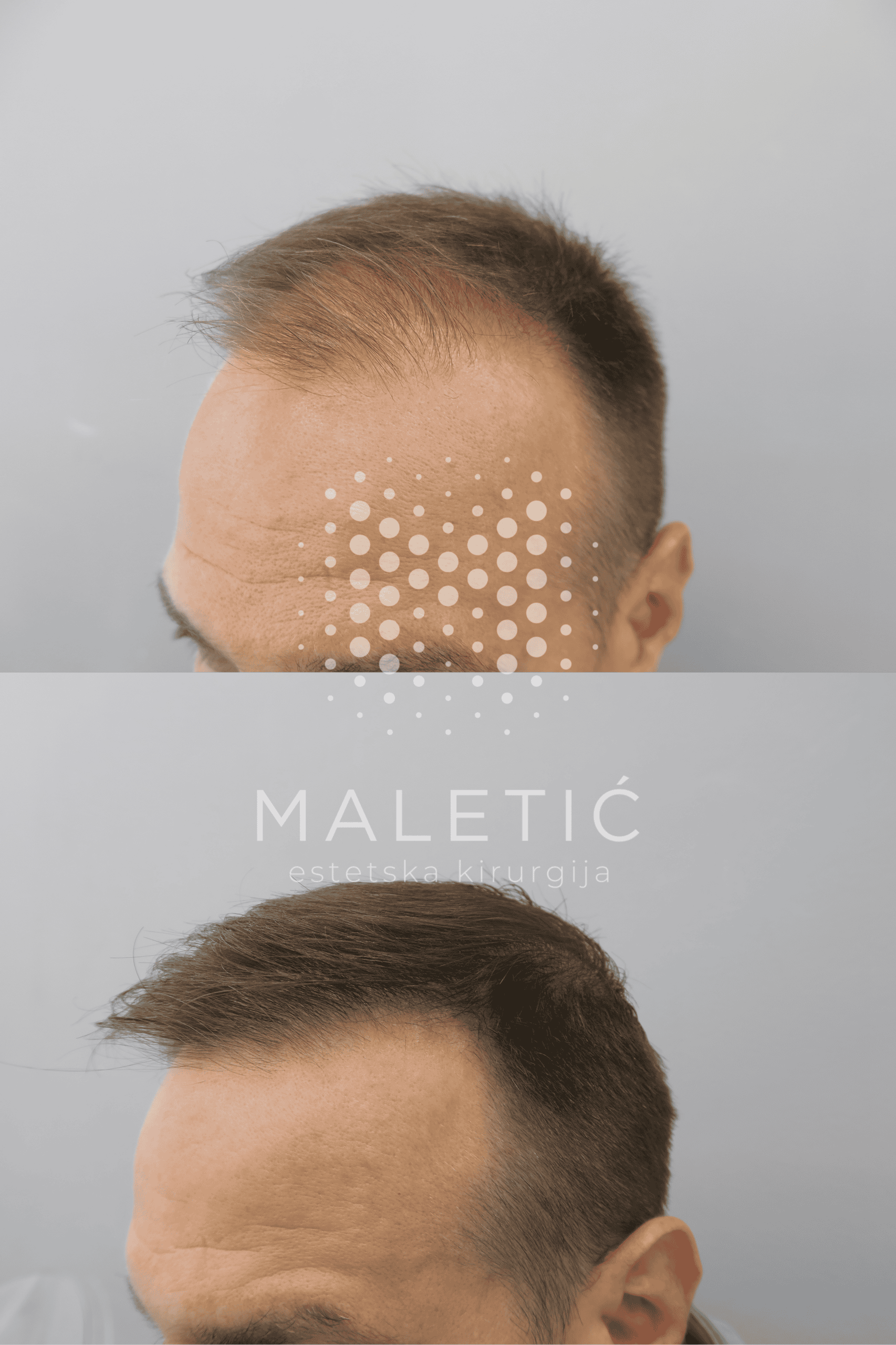 Transplantacija kose FUE