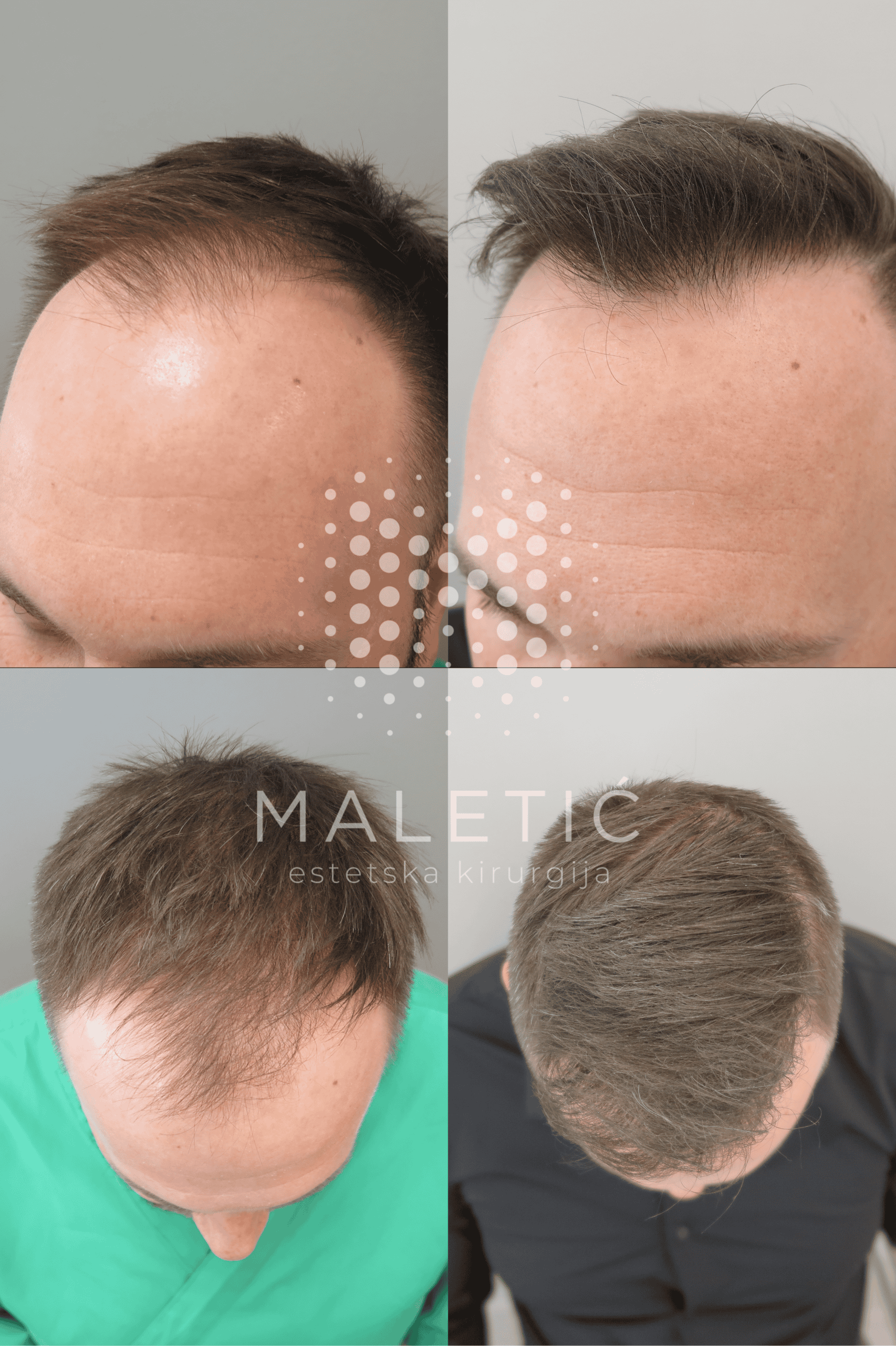 Transplantacija kose FUE 3