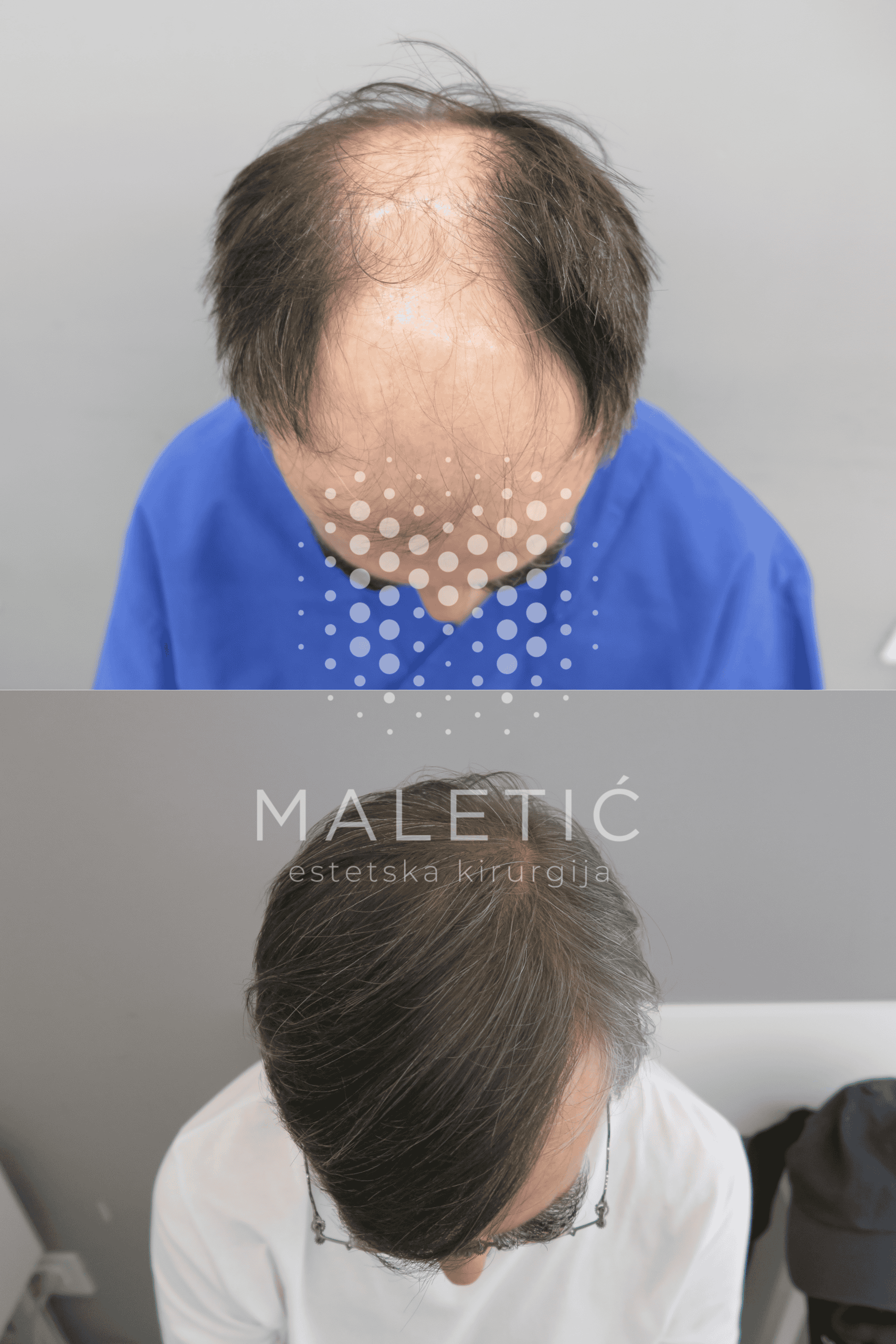 Transplantacija kose prije i poslije tijeme