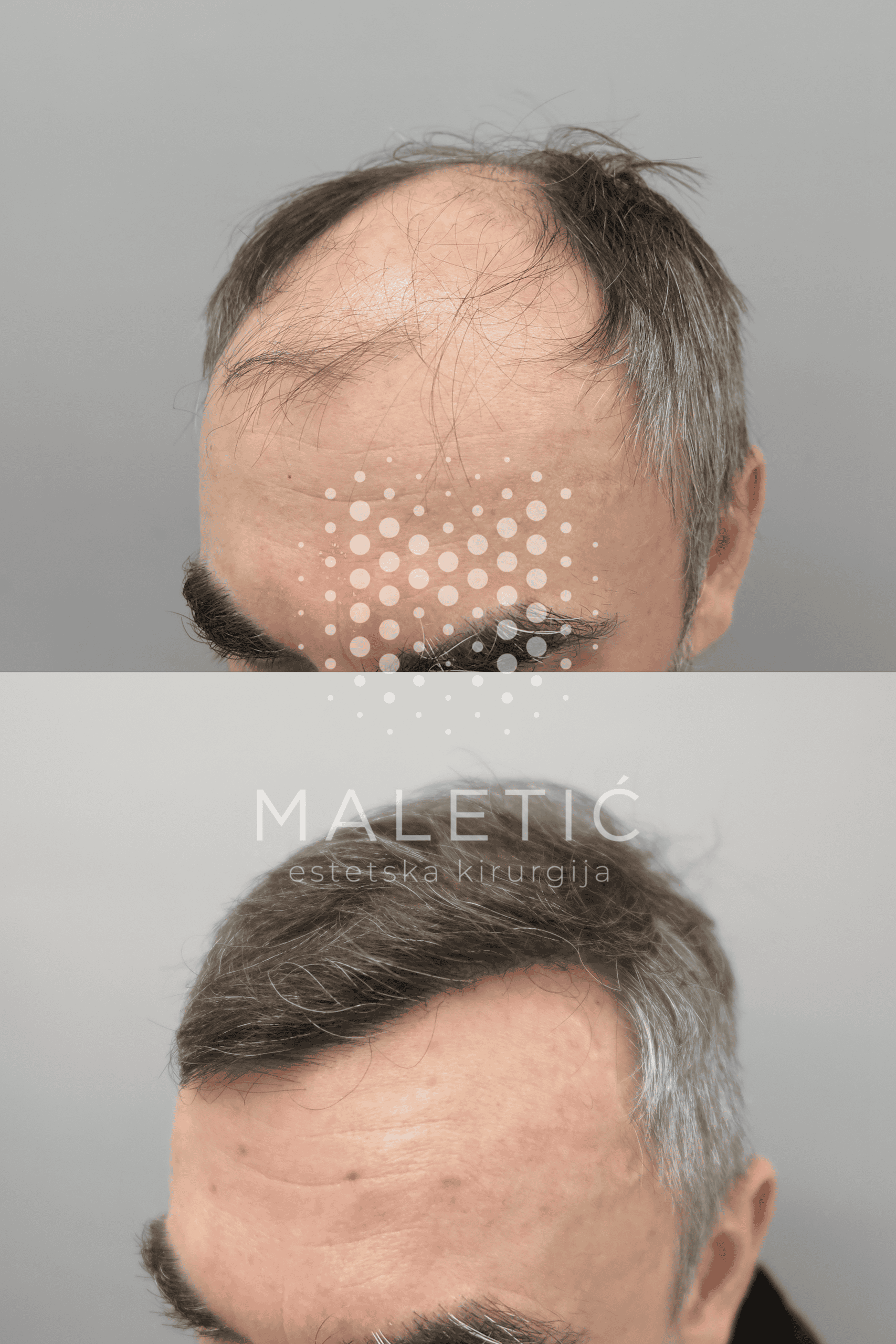 transplantacija kose prije i poslije čelo