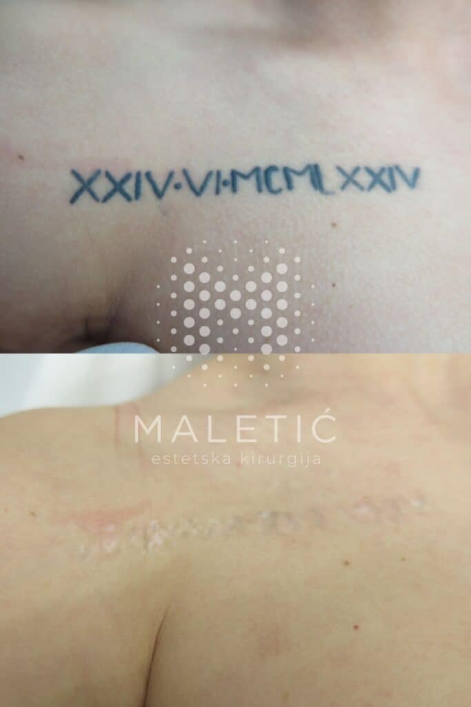 Lasersko uklanjanje tetovaže