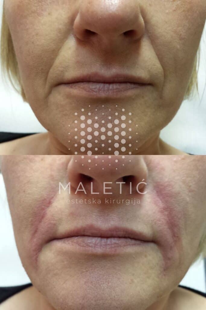 Dermalni filer za lice