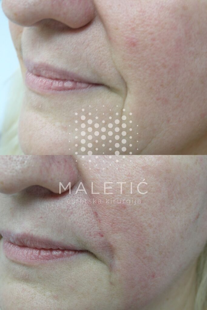 Dermalni filer za lice