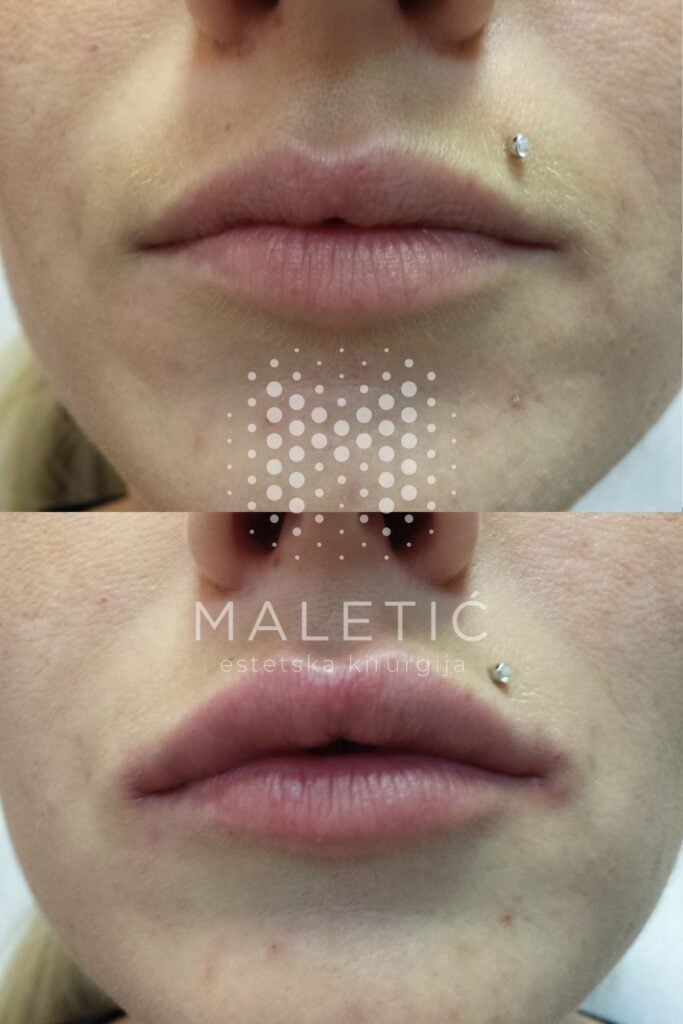 Dermalni filer za usne