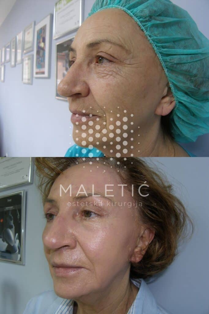 Kemijski piling lica (Exoderm)