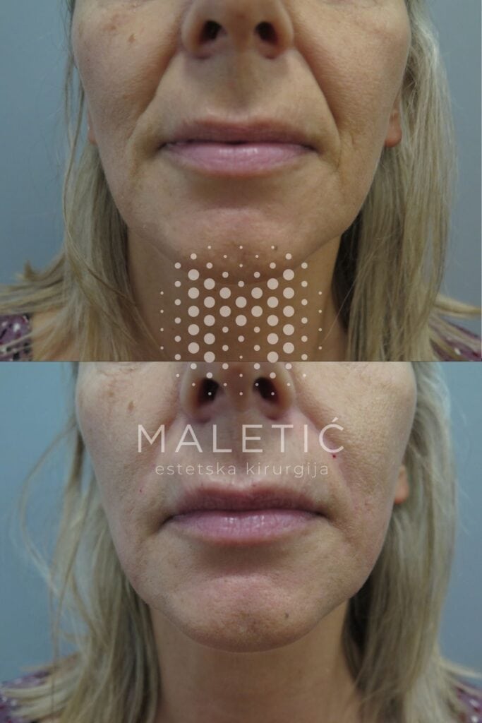 Dermalni filer za lice