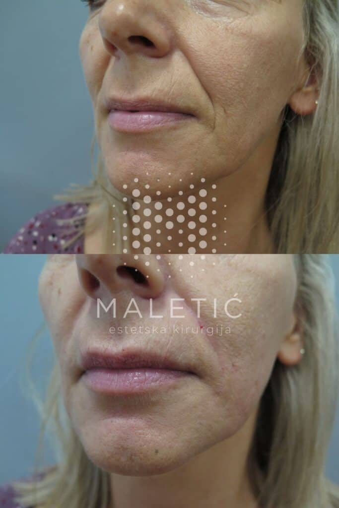 Dermalni filer za lice