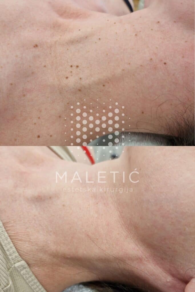 Lasersko uklanjanje fibroma