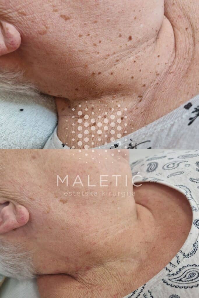 Lasersko uklanjanje fibroma