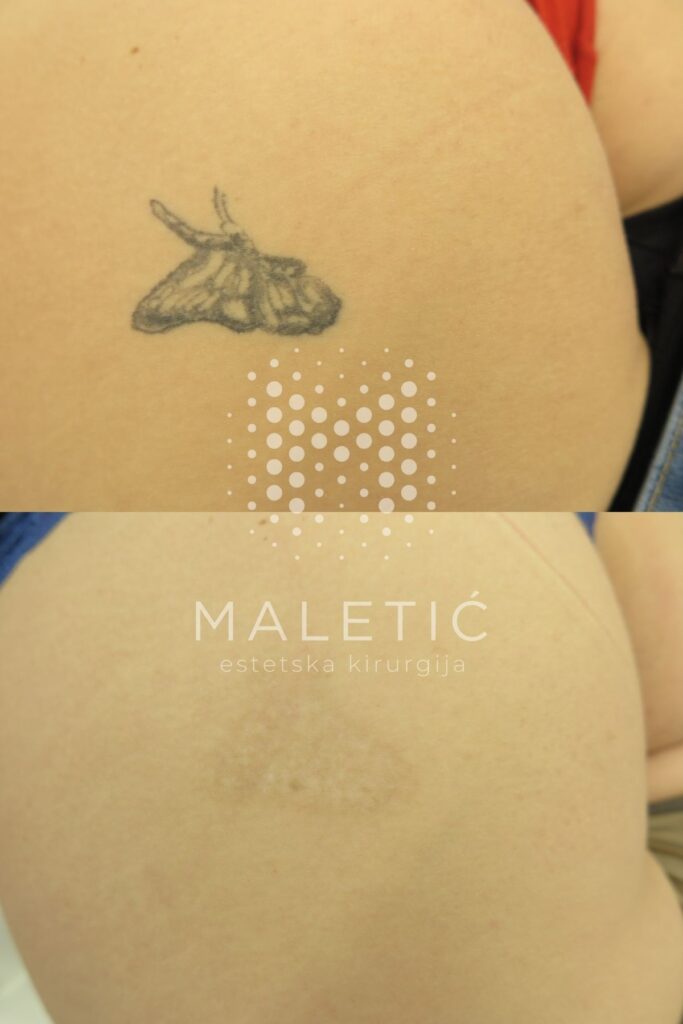 Lasersko uklanjanje tetovaže