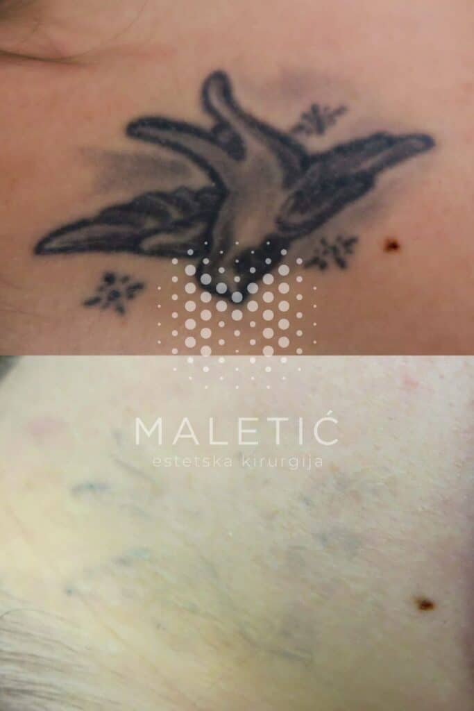 Lasersko uklanjanje tetovaže