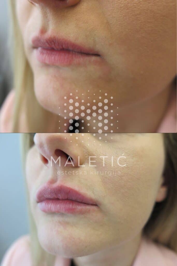 Dermalni filer za usne