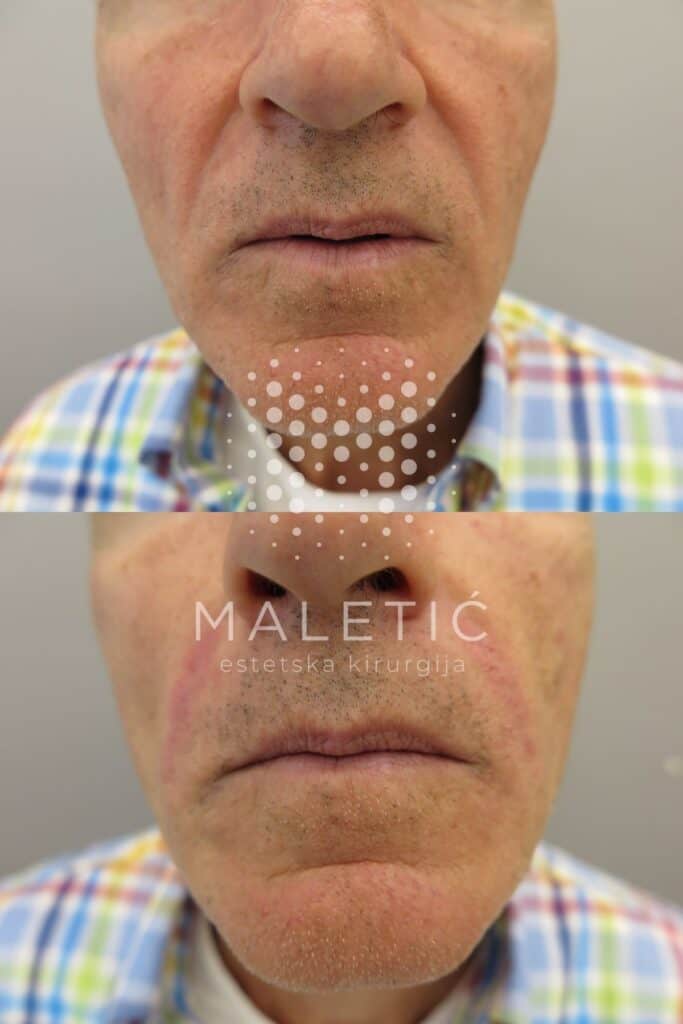 Dermalni filer za lice