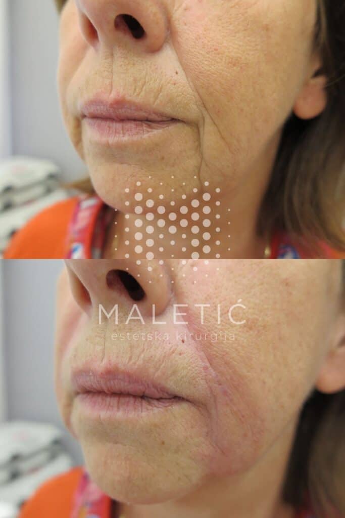 Dermalni filer za lice