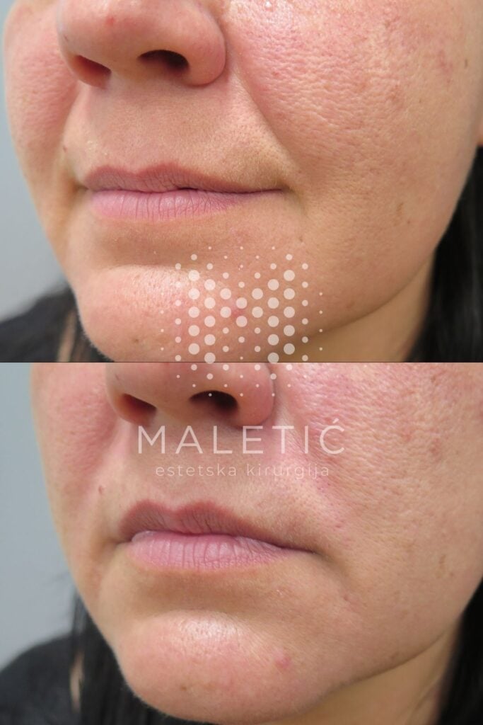 Dermalni filer za lice