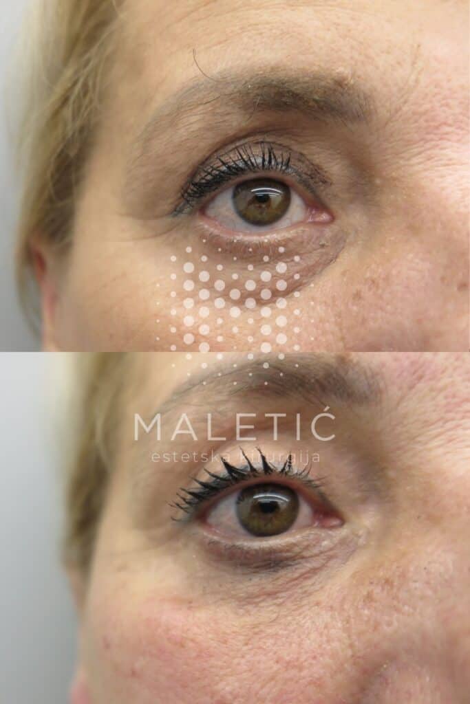 Dermalni filer za lice