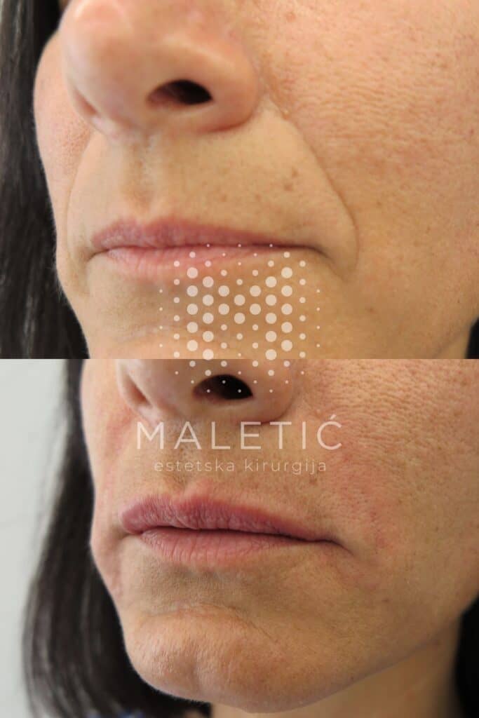 Dermalni filer za lice