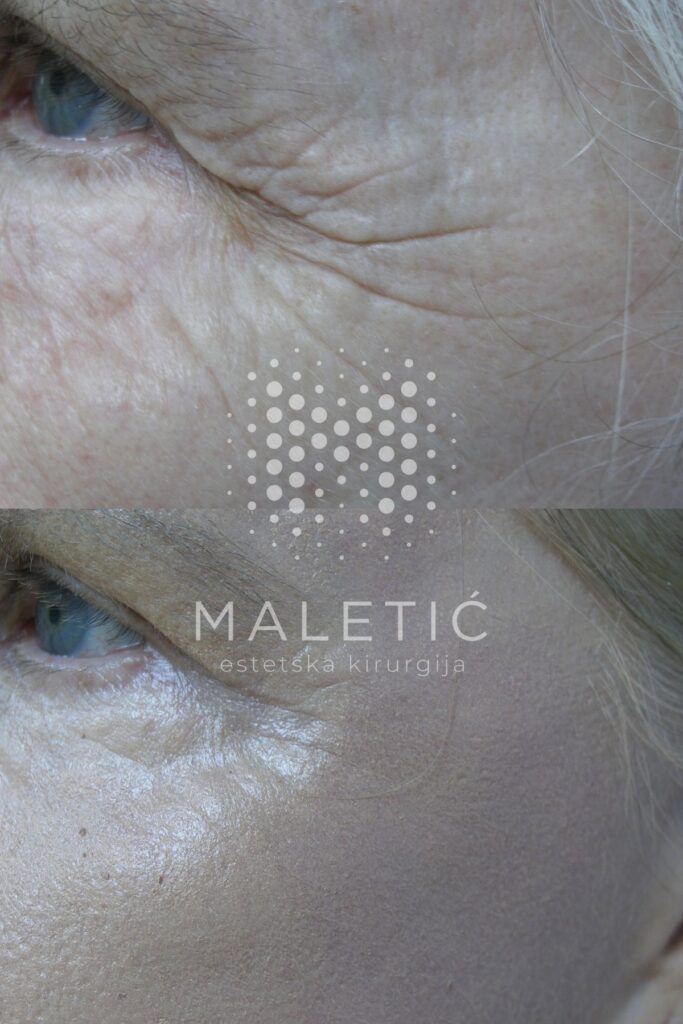 Kemijski piling lica - oko(Exoderm)