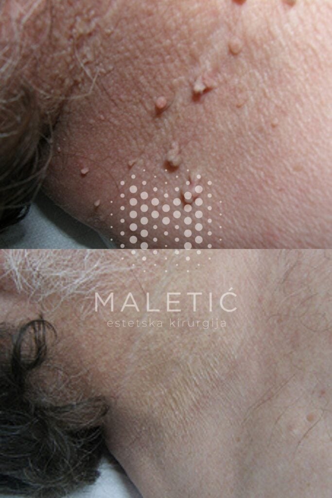 Lasersko uklanjanje fibroma