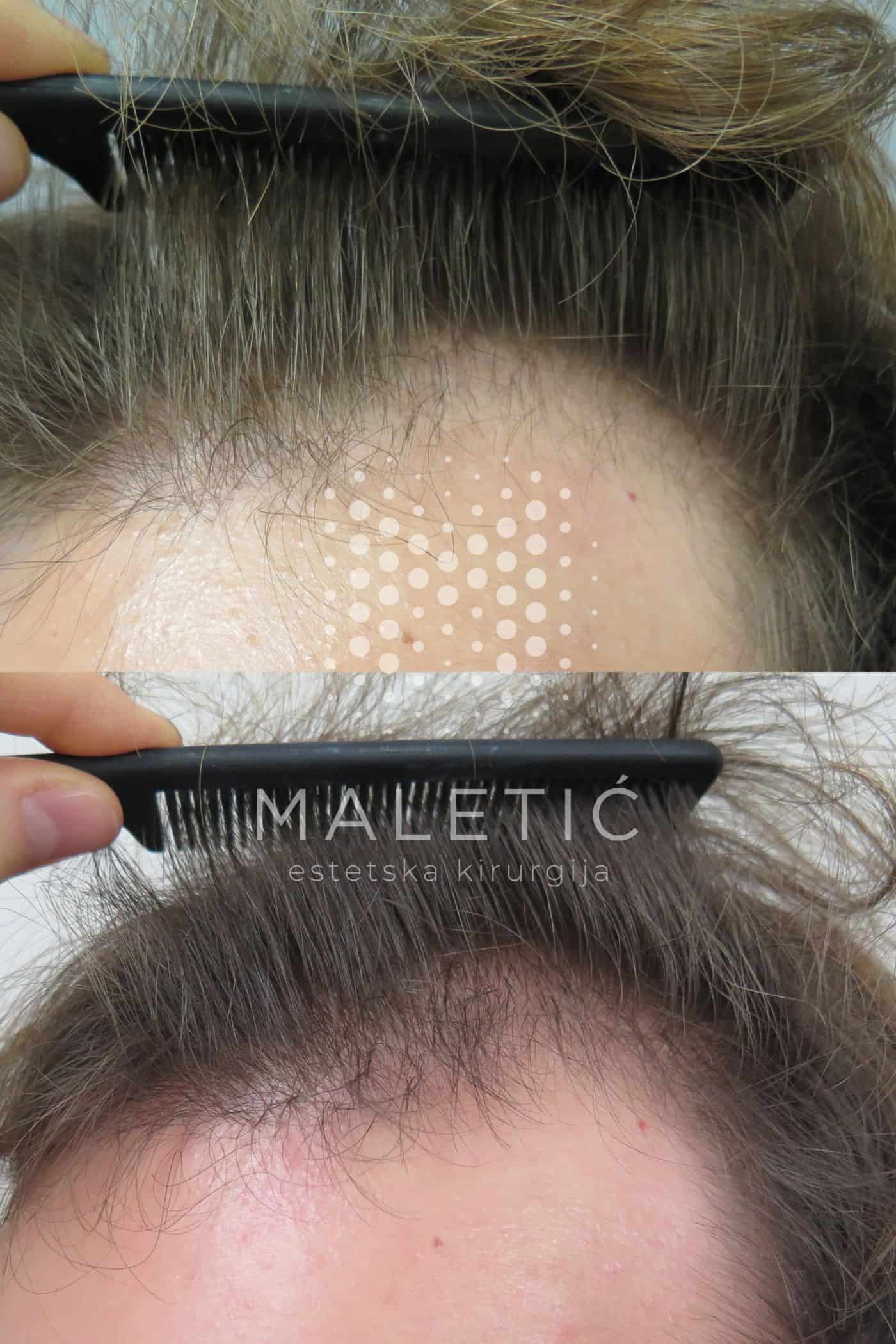 Laser za kosu Poliklinika Maletić