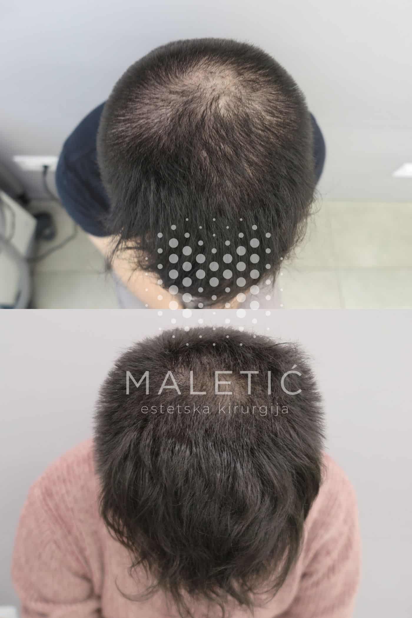 Laser za kosu Poliklinika Maletić