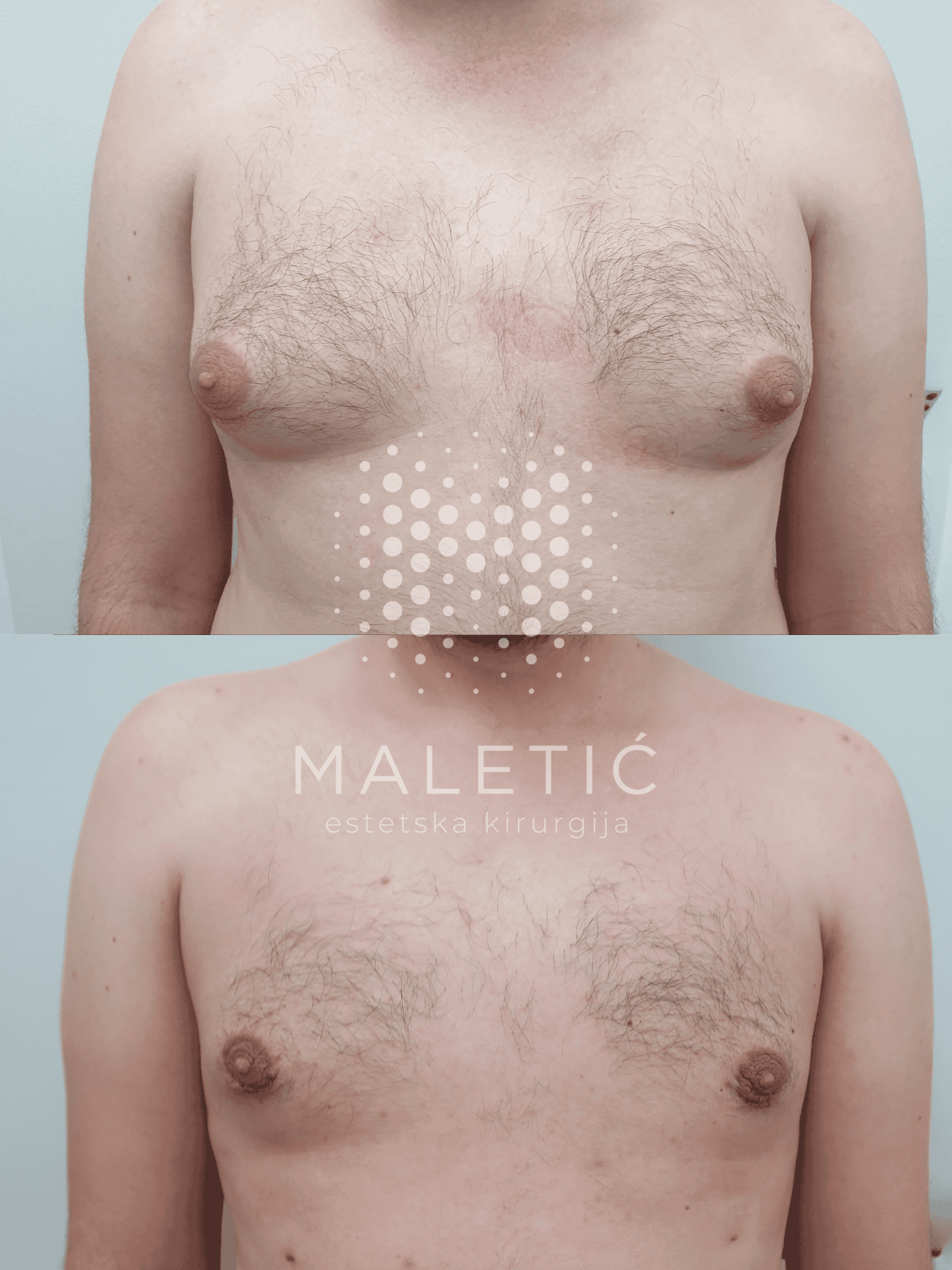 ginekomastija prije i poslije