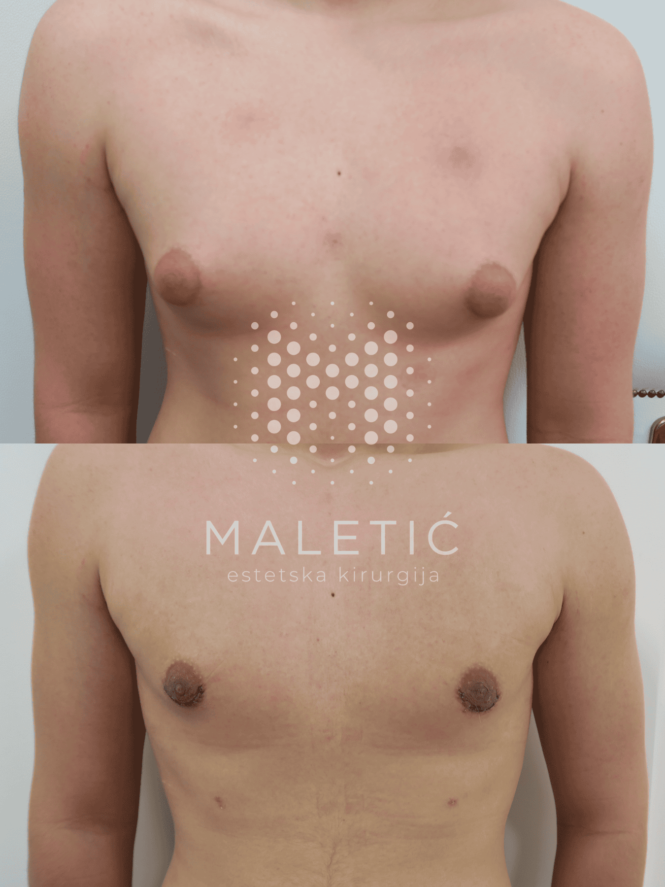 ginekomastija prije i poslije