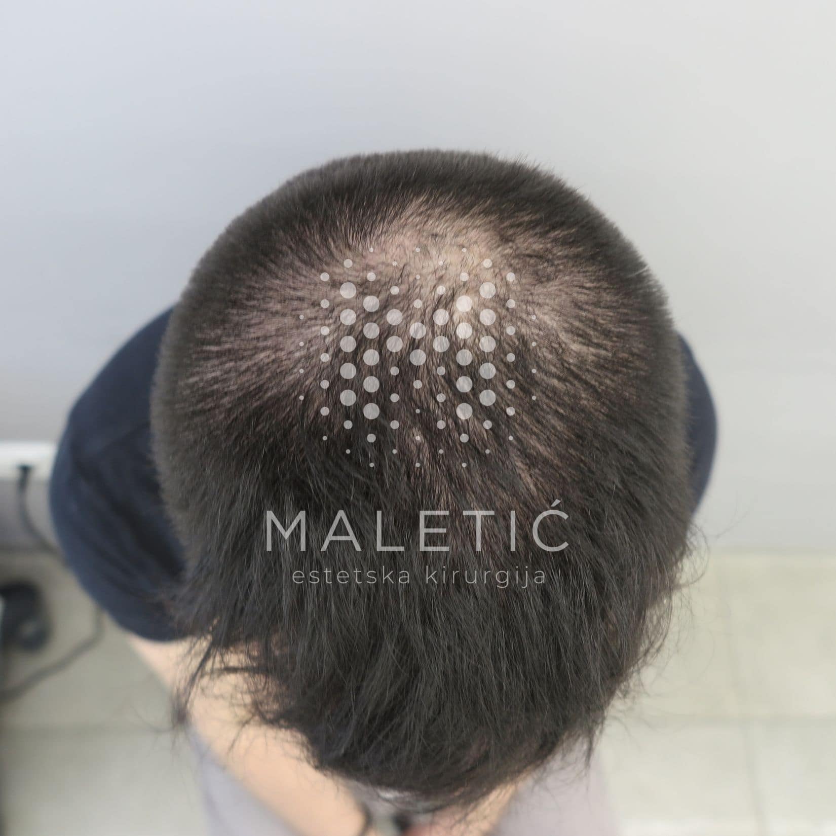 Laser treatment for hair - initial condition