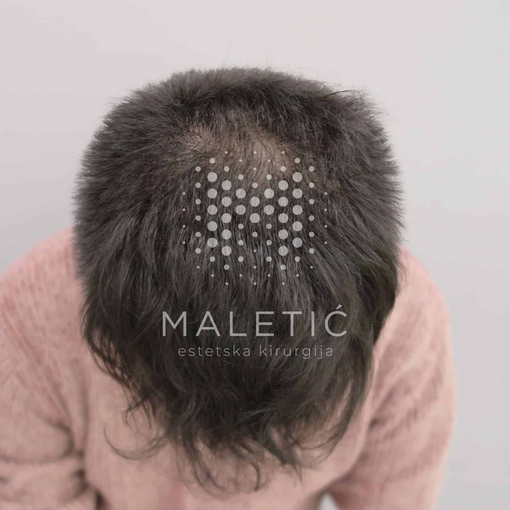 Laser treatment for hair - after
